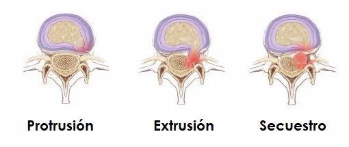 Protrusión, extrusión y secuestro: los tres grados de una hernia de disco