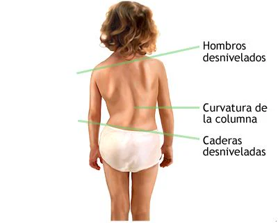 Señales visibles de una escoliosis: hombros y caderas desnivelados