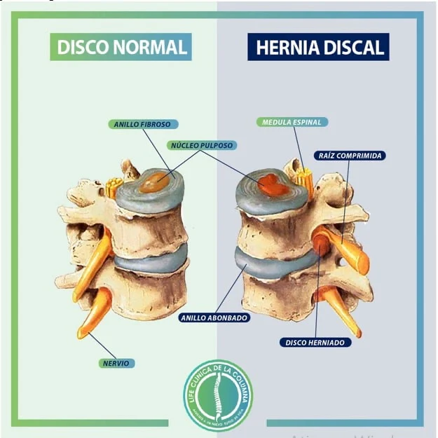 Disco intervertebral normal comparado con una hernia discal