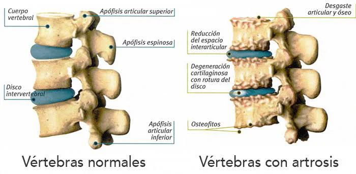 Vértebras sanas frente a vértebras con artrosis