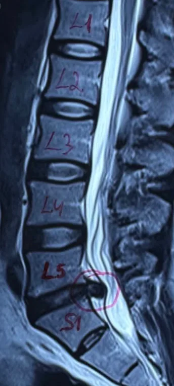 Resonancia magnética lumbar de agosto de 2024, con el nivel L5-S1 señalado