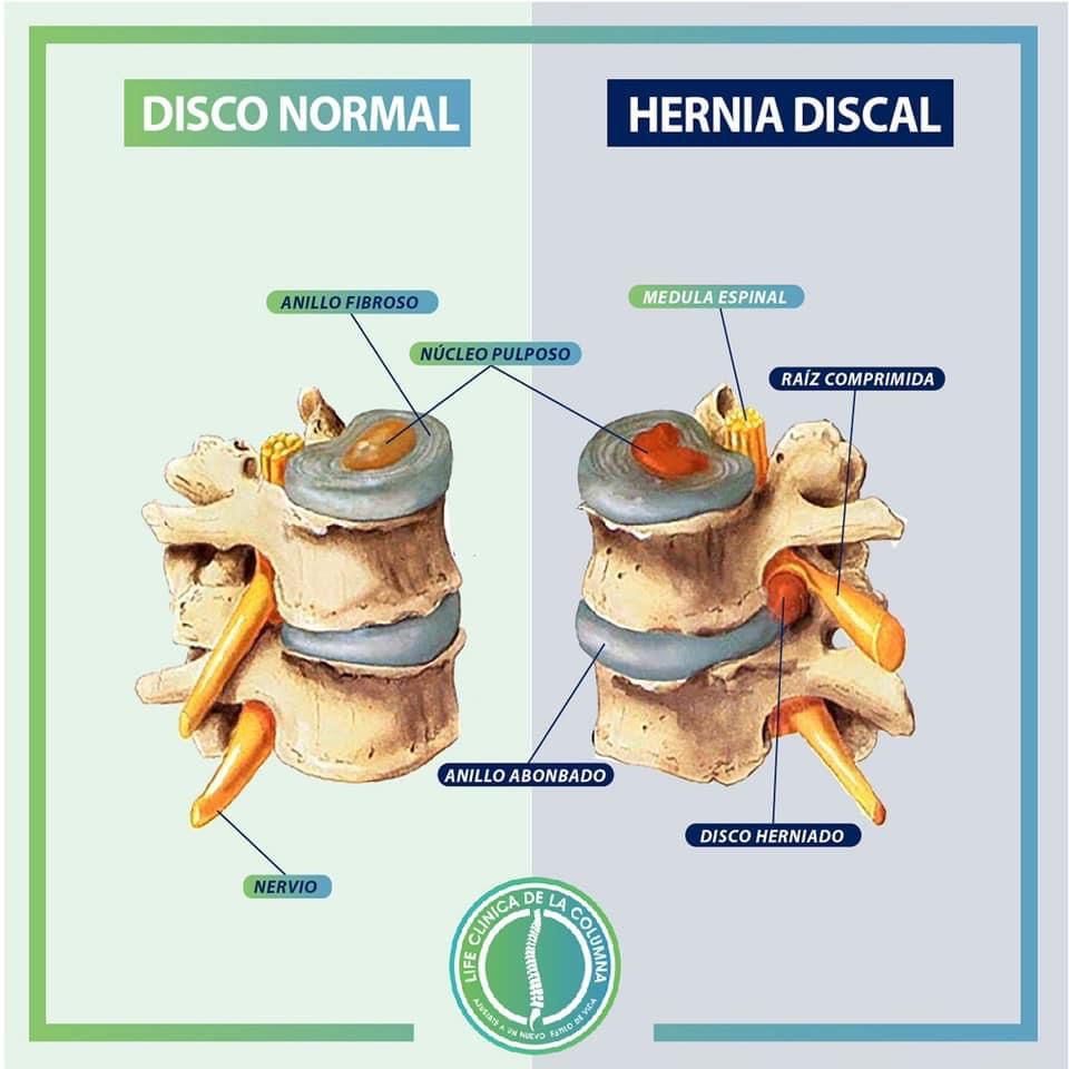 Hernia de disco