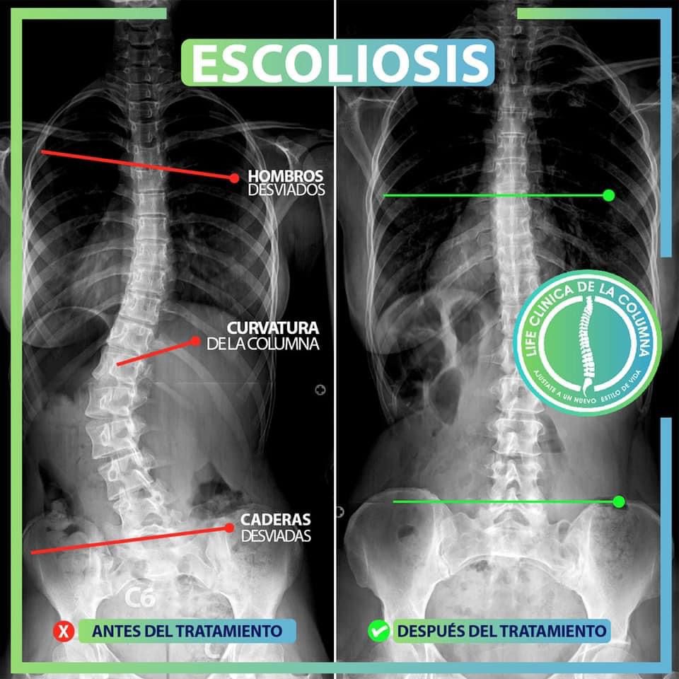 ¿Qué es la escoliosis?